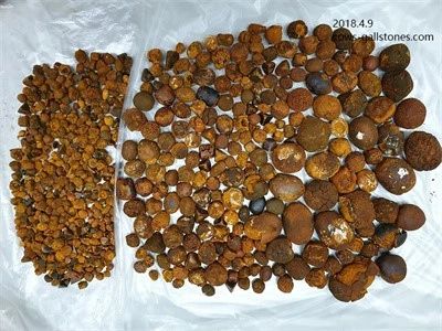 4.9 buy ox gallstones
